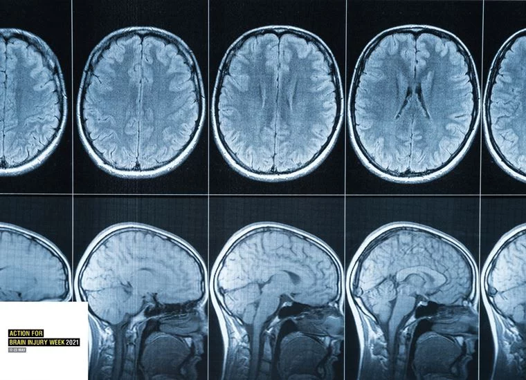 Brain x-ray
